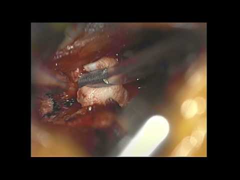 Microdiscectomy in the Lumbar Region