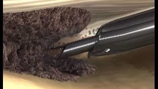 Tenex Procedure for Plantar Fasciitis with Podiatrist Dr. Gabriel Maislos