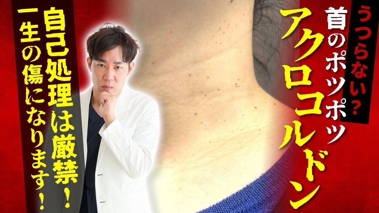 【首のブツブツ、アクロコルドンとは？】首のイボの正体は加齢？アクロコルドンの原因とは？摩擦・紫外線・加齢の影響を皮膚科専門医が徹底解説