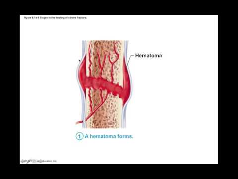 Chapter 6.7 Bone Repair BIO201
