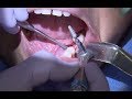 Case Of The Week The Fundamentals Of Placing Implants