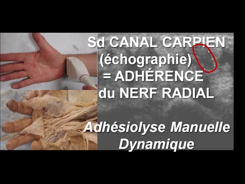 comment guerir syndrome canal carpien