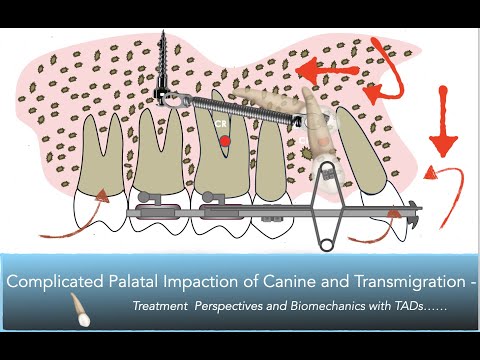 [LECTURE :11] Complex Palatal Impaction of Canine Treated with TADS | Transmigration | Biomechanics