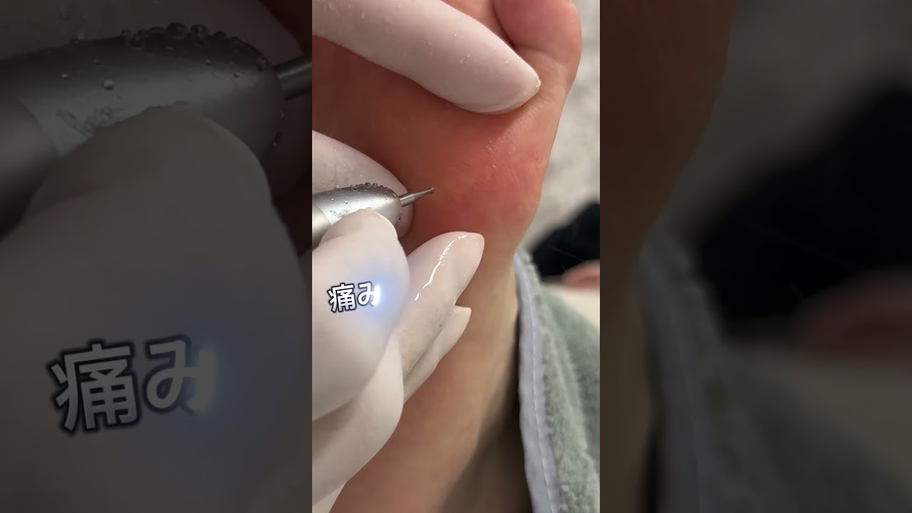 【魚の目ケア】#shorts