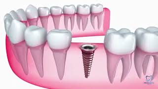 Diş İmplantı | Smiley Dental Antalya | Antalya Diş Kliniği