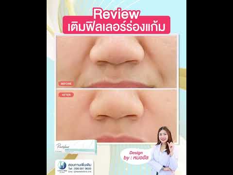 รีวิวโปรแกรมฟิลเลอร์ร่องแก้ม