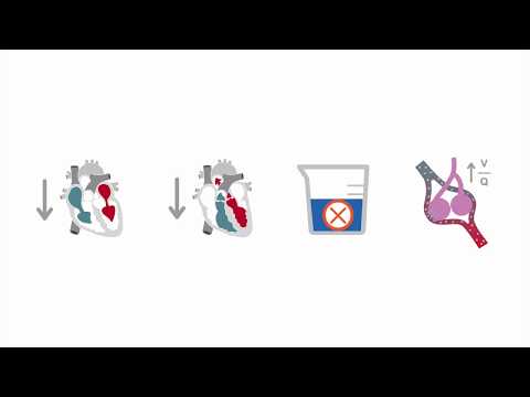 Applying CPAP in pulmonary edema