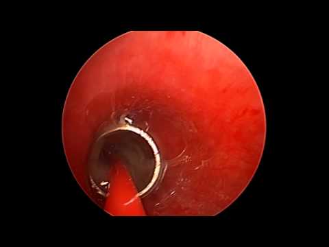 Foreign Body Bronchus Retrieval by Fogarty Catheter