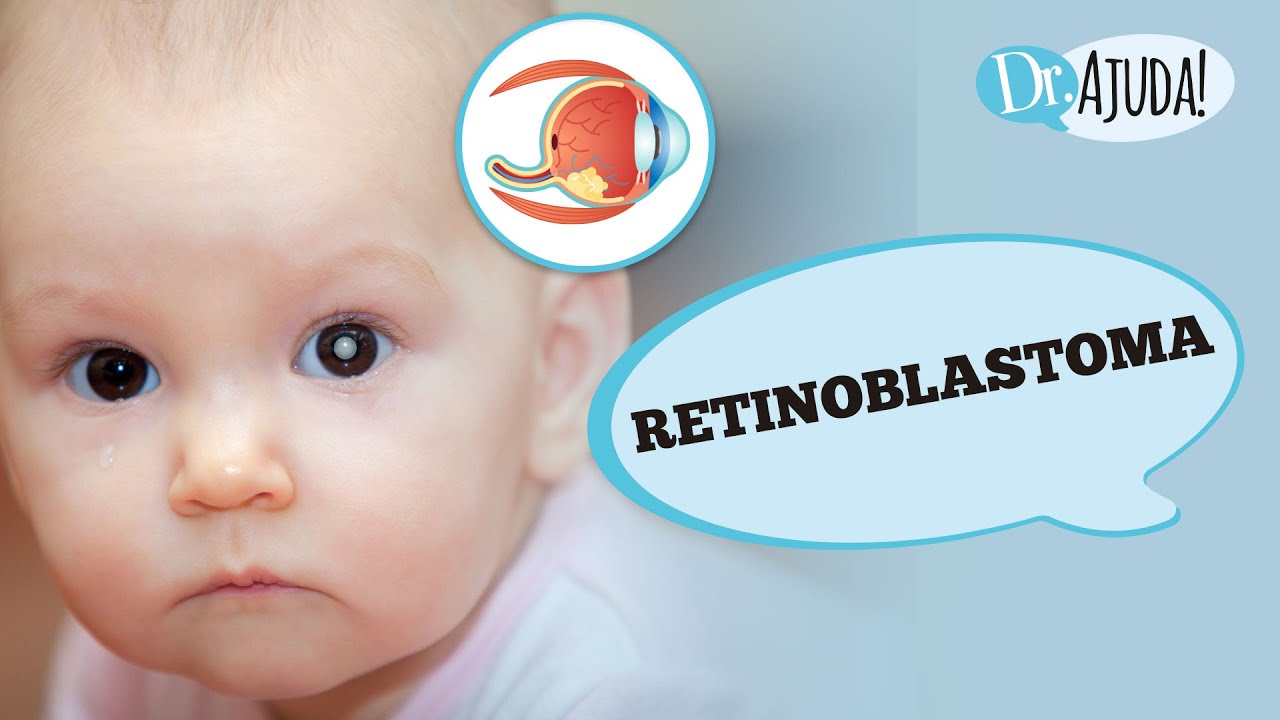 O RETINOBLASTOMA: O QUE É? SINTOMAS  E TRATAMENTO