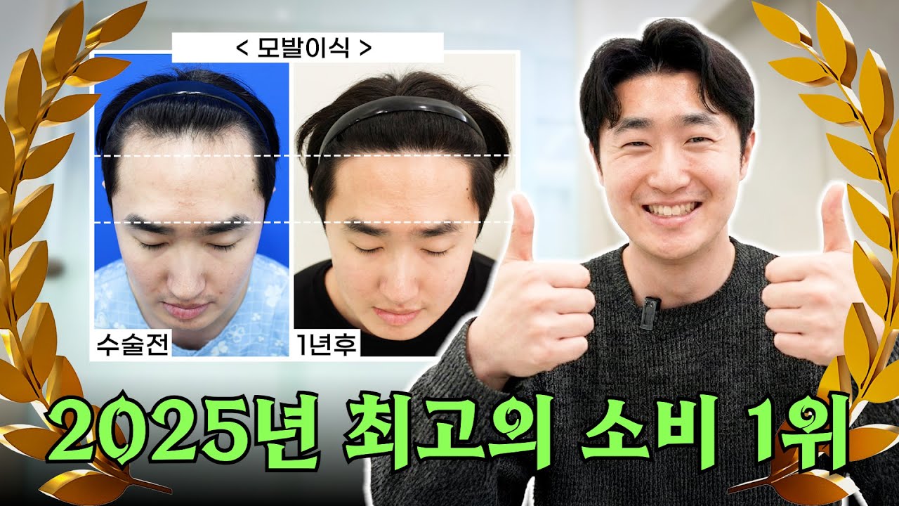 돈 값 제대로 합니다! 빨리 머리 심으세요 ㅣ 모발이식 1년 후기