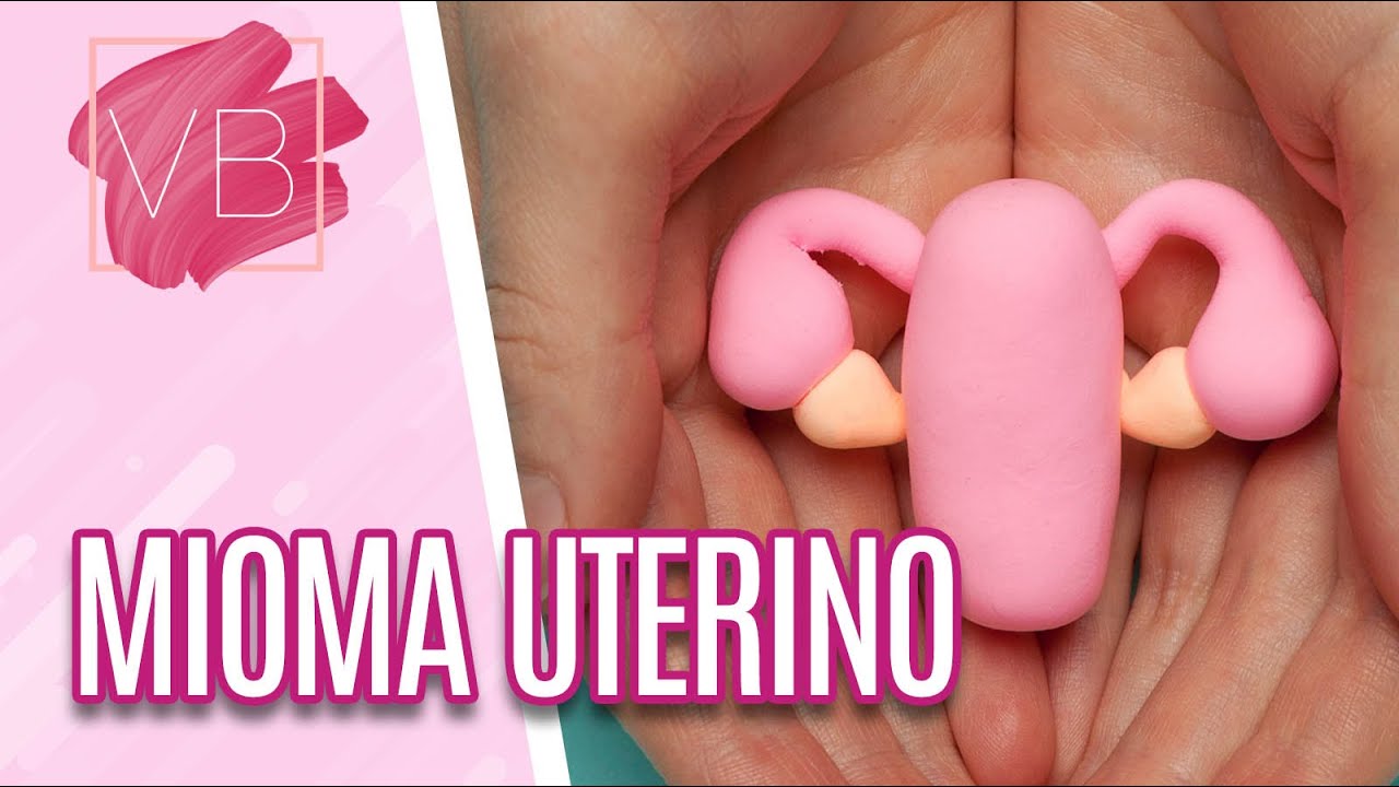 Mioma uterino: causas, sintomas e tratamentos - Você Bonita (27/01/21)