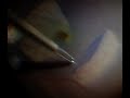 Modified ILM Flap Technique in Macular Hole Surgery