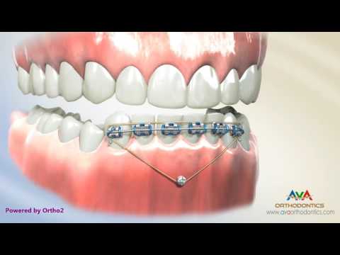 Orthodontic Treatment for Deepbite - Temporary Anchorage Device or TAD