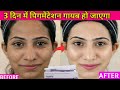 Tyrodin cream review in 2023 | best cream for Pigmentation?