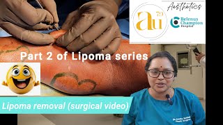 Lipoma removal surgery