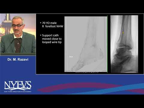 Crossing Techniques for Below the Knee CTO's Is there a Universal Algorithm Mahmood RazaviSession II