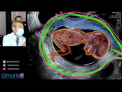 ULTRASSONOGRAFIA: Gravidez de 12 semanas com imagens 3D/4D.
