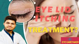 Eye itching: cause,treatment|Blepharitis Treatment|आखों की खुजली का इलाज |