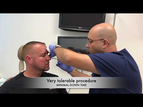 Male Cheeks Fillers by DR. Sharabi