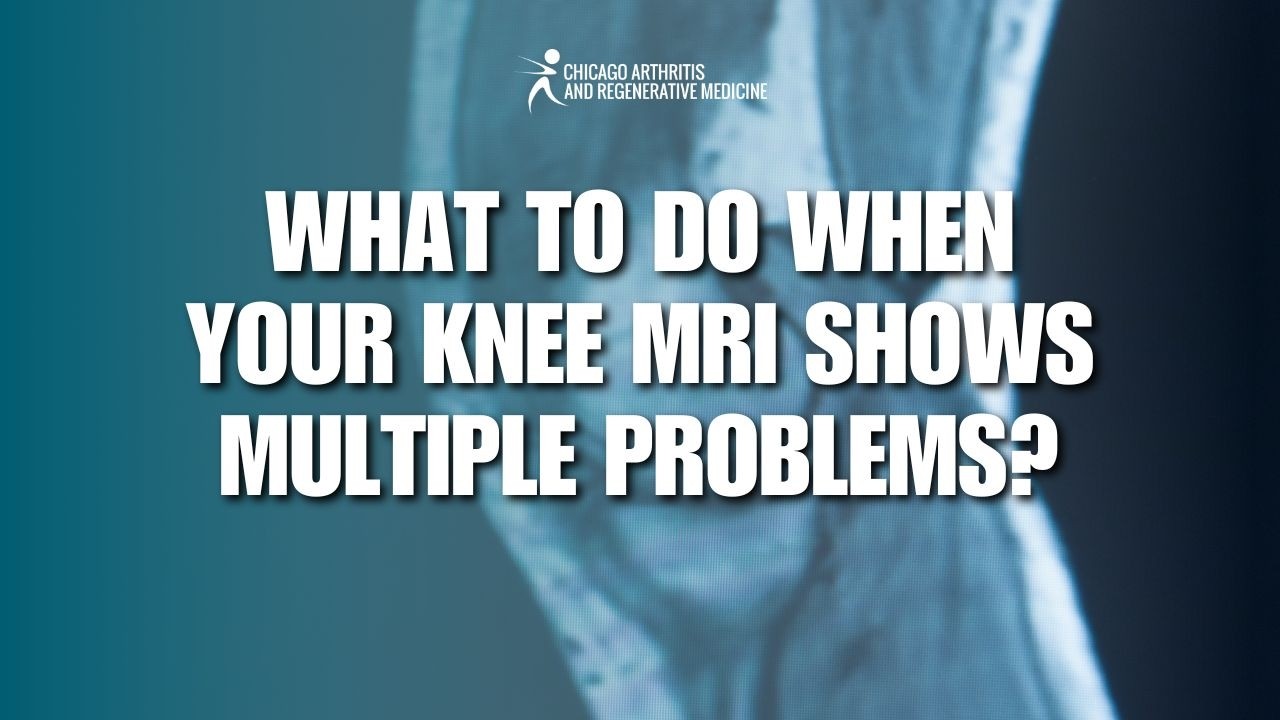 What to Do When Your Knee MRI Shows Multiple Problems