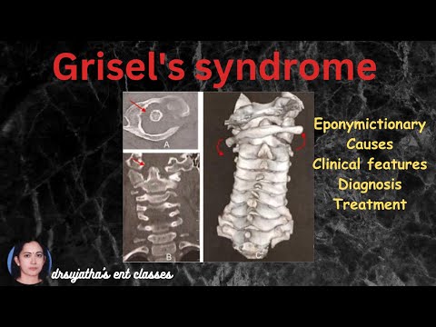 258.Grisel's syndrome : Syndromes in ENT #surgeryeducation