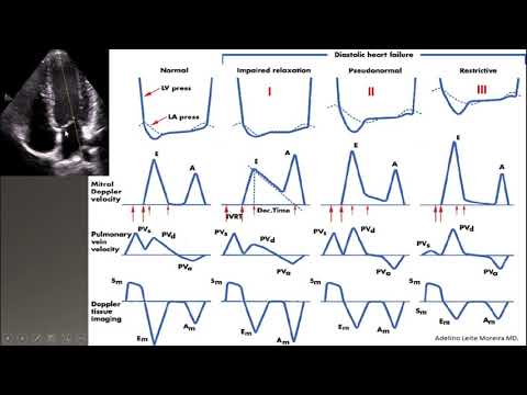 diastolic dysfunction part II-grading ASE 2016