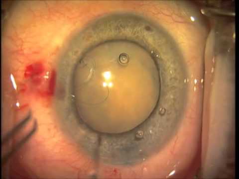 Subluxated Hypermature Cataract and Cionni Ring