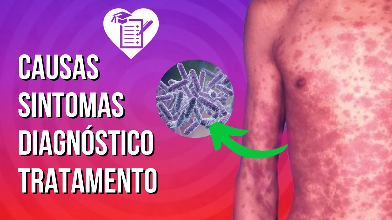 PÚRPURA TROMBOCITOPÊNICA IDIOPÁTICA - Uma Doença Hemorrágica de Origem Autoimune