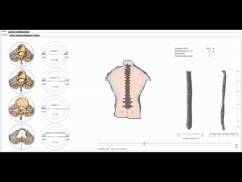 Behandlung von Bandscheibenbruch in Orenburg Schwindel von Gebärmutterhalskrebs Übungen degenerative Bandscheibenerkrankungen