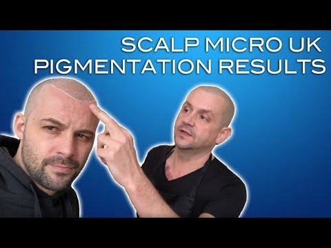 Il pigmentary nota su un dorso e un corpo come liberarsi Il rimedio più efficace da pigmentary nota su mani