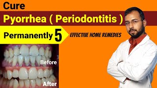 Pyorrhea treatment at home | pyorrhea home remedies | Periodontitis Treatment - teeth whitening