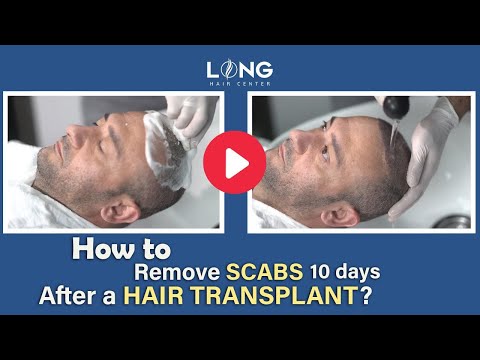 How to remove all scabs 10 days after a hair transplant?