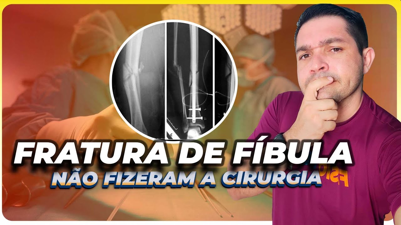 Fratura de Tíbia e Fíbula:  A Fíbula sem Cirurgia e agora?