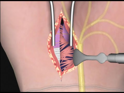 Carpal Tunnel Surgery by Cal Shipley, M.D.
