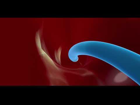 Prostate Artery Embolization