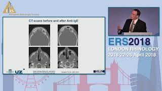 Download Lagu ERS London 2018, Novel Treatments For CRSwNP, Claus Bachert Thumbnail