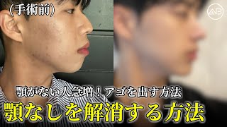 顎がない人急増！アゴを出す方法 | AB美容整形