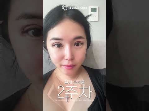 절개 쌍꺼풀 전후 2개월