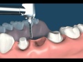 Process Of 3 Unit Bridge