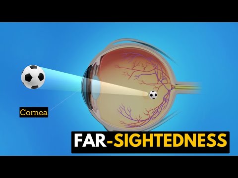 Far sightedness Causes Signs and Symptoms Diagnosis and Treatment