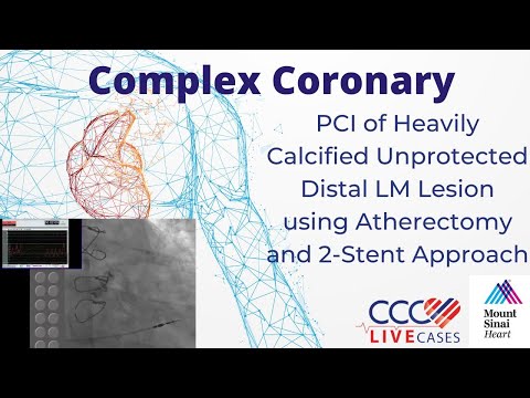 PCI of Heavily Calcified Unprotected Distal LM Lesion using Atherectomy & 2-Stent Approach -Jul 2014