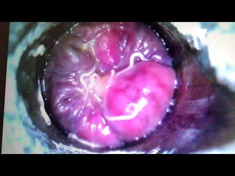 Vérszegénység parazitát okoz - A pinworm test farok vége