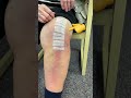 Suture Strips