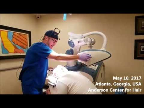 LIVE ARTAS Robotic Hair Transplant Surgery - see follicles removed by a robot