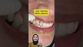 Download lagu TAMBAL GIGI DEPAN YANG BERLUBANG #caries #dentist #edukasi #doktergigi #magelang mp3 Download lagu TAMBAL GIGI DEPAN YANG BERLUBANG #caries #dentist #edukasi #doktergigi #magelang mp3