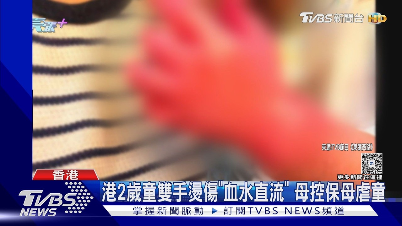 影音/港母控印尼保母虐2歲女!雙手遭燙傷「皮脫見肉」恐需植皮