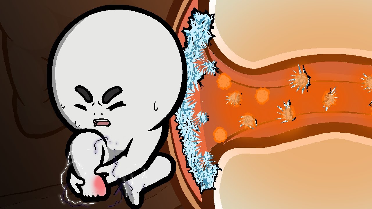 痛風になる仕組み