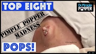 EIGHT POPS for you - PIMPLE POPPER MADNESS!!