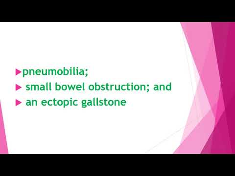 The classic Rigler's triad of gallstone ileus