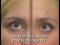 Horizontal Gaze Nystagmus Test - HGN - NHTSA horizontal gaze eye movement test